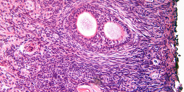 SOPK devient SMOP : pourquoi le syndrome des ovaires polykystiques change de nom